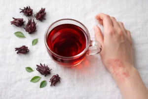 A glass of deep red hibiscus tea beside a cotton compress and dried hibiscus flowers for eczema itch relief
